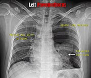 A 65-year-old patient with a background of COPD and a history of heavy smoking